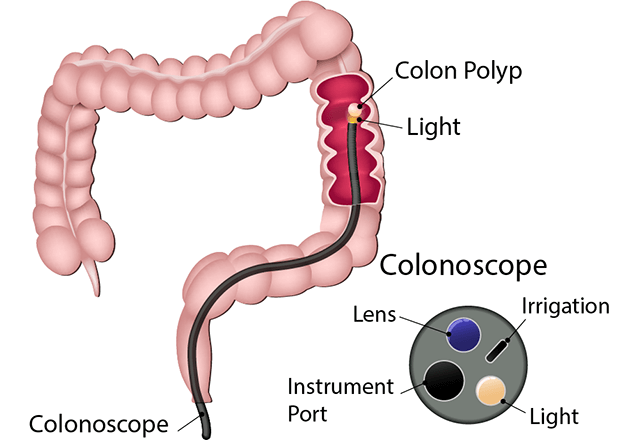 laproscopic